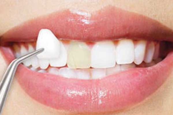إزالة الفينير من الأسنان