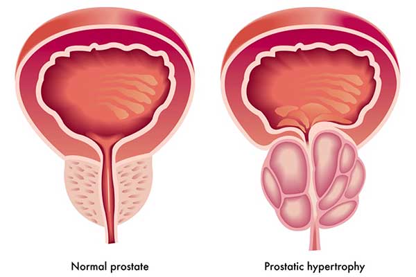 Prostataoperation