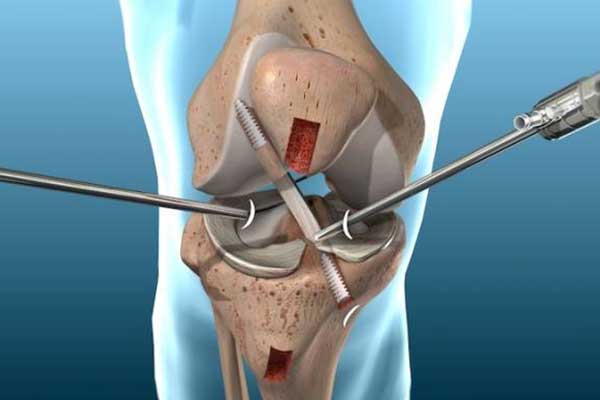 Chirurgie arthroscopique du genou
