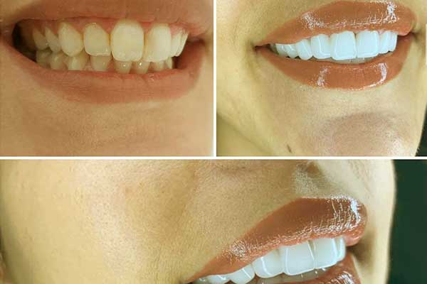hollywood smile turkey before and after