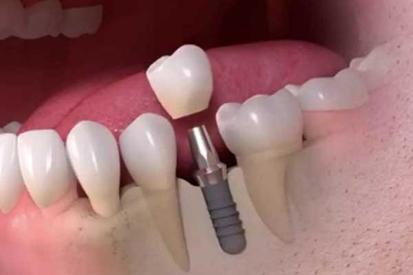 زرع الأسنان في تركيا: تحقيق ابتسامة مشرقة وصحة فموية مثالية