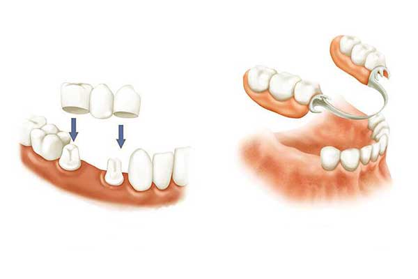 الفرق بين طقم الأسنان الجزئي المتحرك والثابت