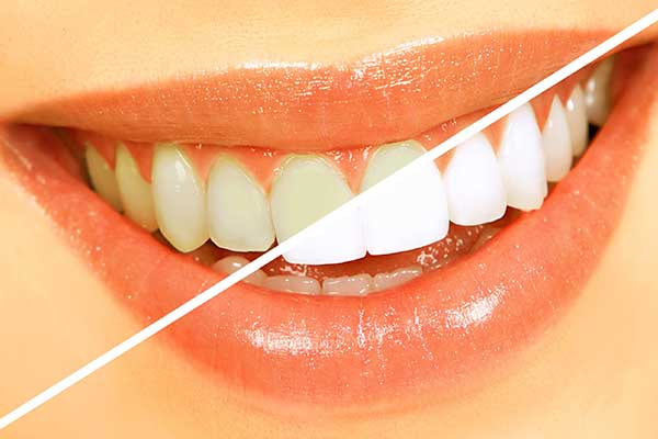 إزالة تصبغات الأسنان في المنزل – طرق علاج التصبغات
