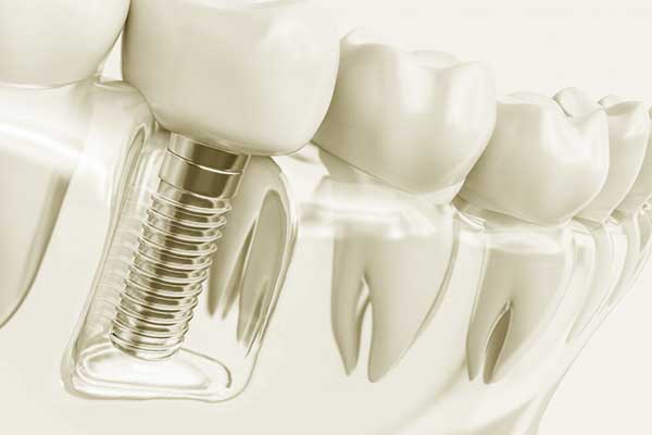 مشاكل تركيبات الأسنان الثابتة – الأسباب و العلاج بطرق بسيطة