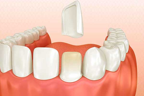 ألم الأسنان بعد تركيب الزيركون – طرق العلاج و الوقاية