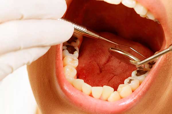 جير الأسنان الأسود – أسبابه و طرق العلاج و الوقاية