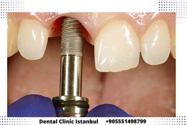 زرع الأسنان في تركيا - مميزات وأسعار أشهر عيادة أسنان
