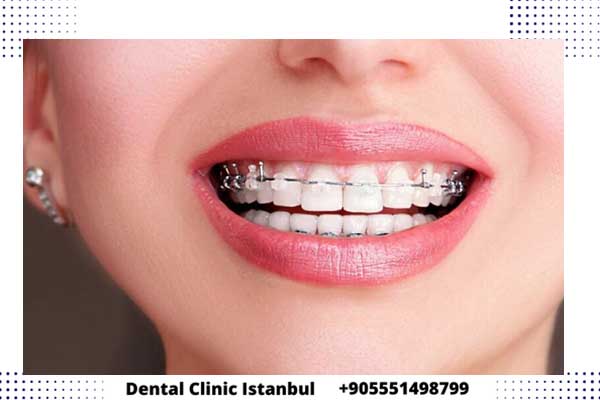 تقويم الاسنان في تركيا - مميزات وعيوب وأسعار كل نوع
