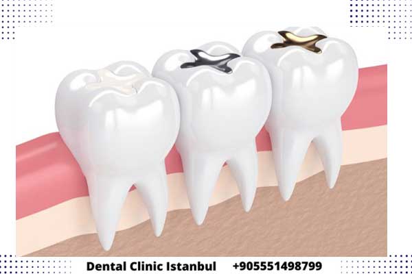 حشو الأسنان في تركيا - دليل إصلاح تسوس الأسنان