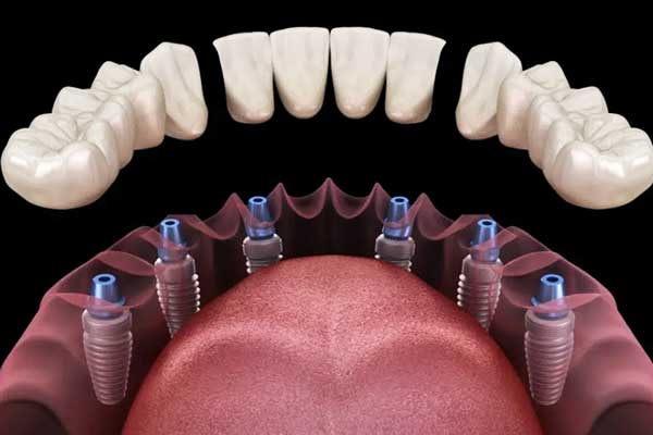 3 von 6 Zahnimplantaten in der Türkei Kostenpaketverfahren