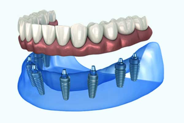 le tout sur 6 implants dentaires coûte des forfaits, des examens et une procédure de dinde