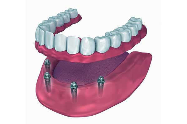 tudo em 4 implantes dentários na Turquia
