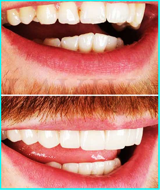 prima e dopo lo sbiancamento dei denti dal dentista