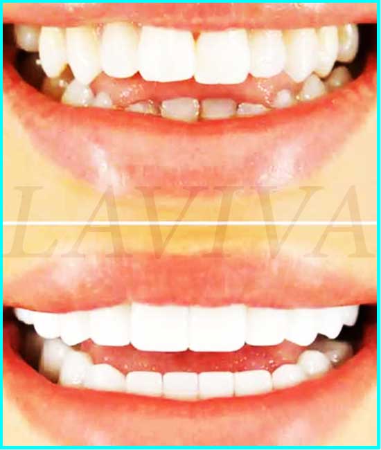 veneers pictures before and after