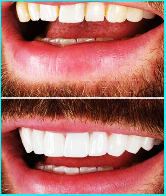 Veneers auf den Zähnen vorher und nachher