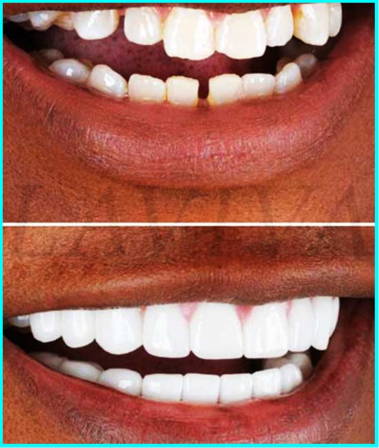 corone dei denti anteriori prima e dopo