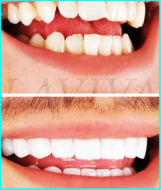 capuchons de dents avant et après