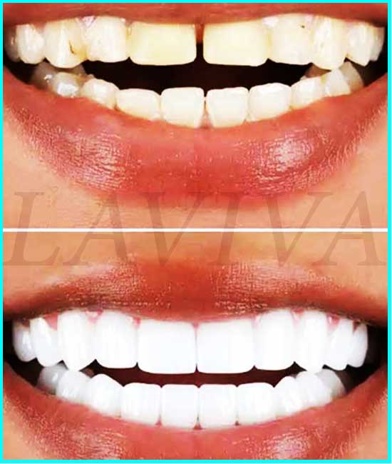 coroas dentárias antes e depois