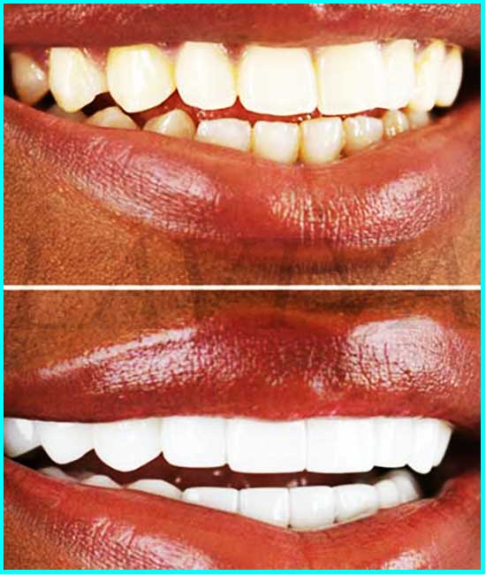 porcelain veneers before and after pictures