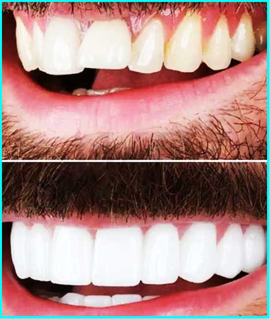 dentista clareando os dentes antes e depois