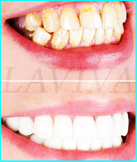 dentes branqueados antes e depois