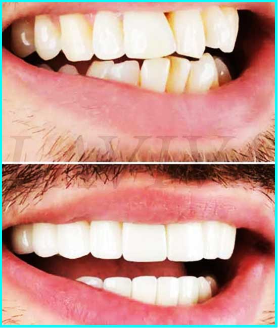 avant et après avec un dentier