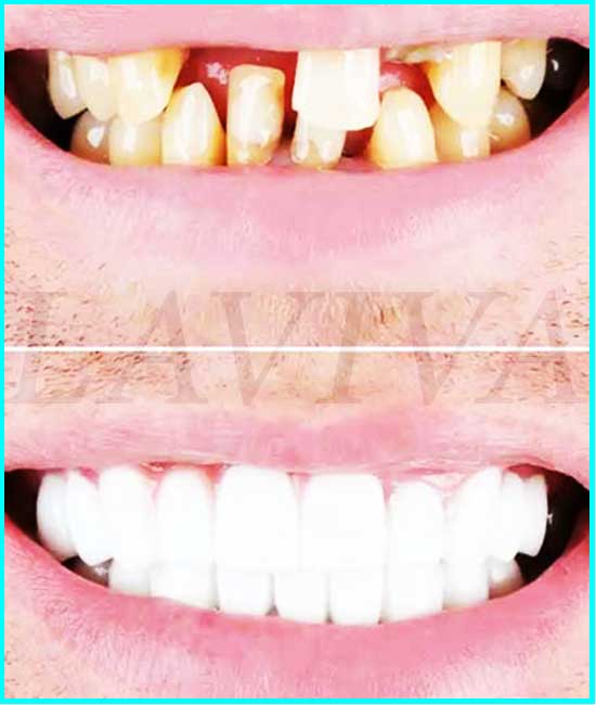 coiffes dentaires avant et après