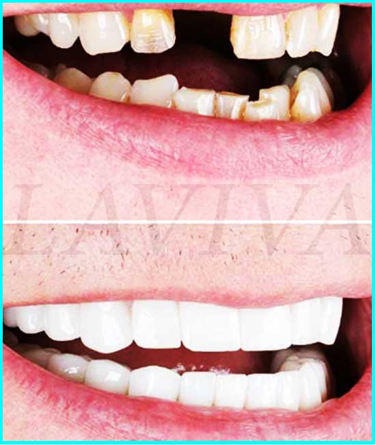 dents avant et après