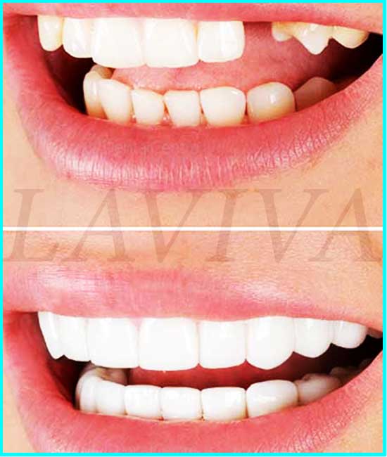 dentes salientes antes e depois
