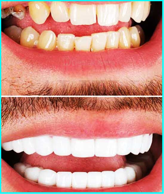 sbiancamento dei denti prima e dopo
