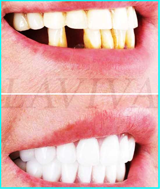 clareamento dental antes depois
