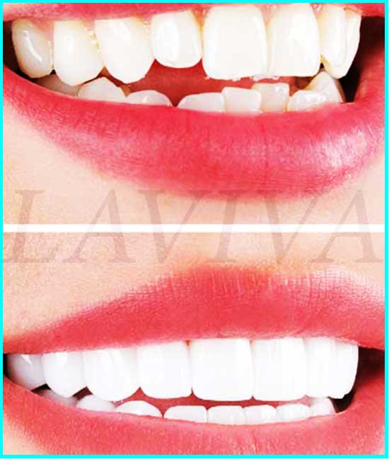 veneers before and after process