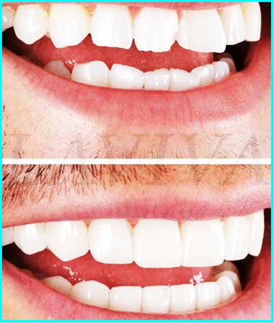 pictures of veneer teeth