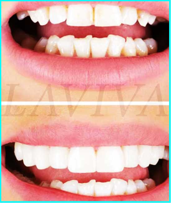 Verklebte Zähne vorher und nachher