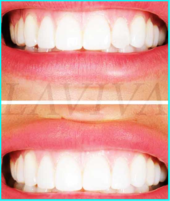 couronnes de dents avant et après
