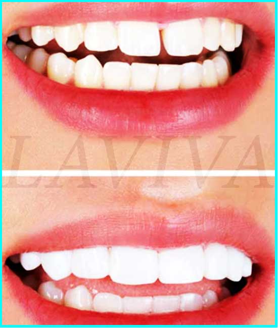 facettes dentaires avant et après