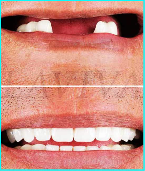 prima e dopo gli impianti dei denti