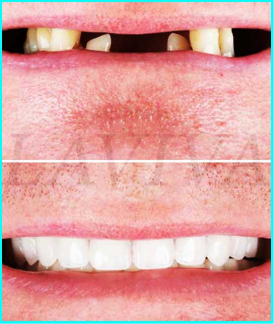 impianto del dente anteriore prima e dopo