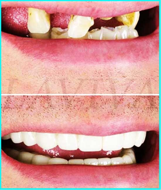 implants dentaires avant et après