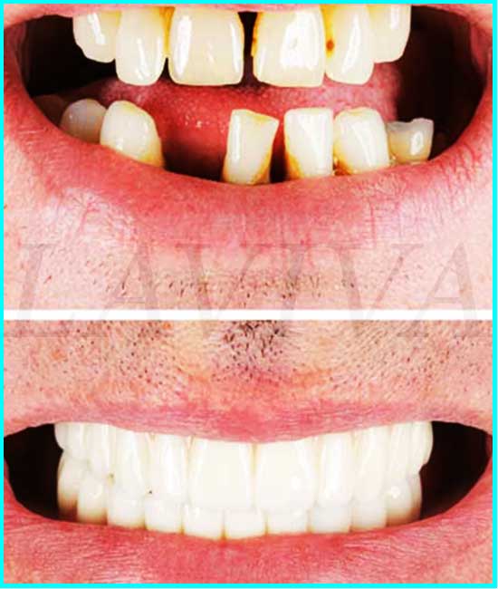 Implantes dentários no mesmo dia