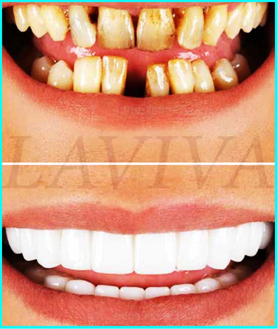 Immagini dei denti dell'impianto dentale