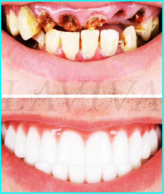 Bilder von Zahnimplantaten