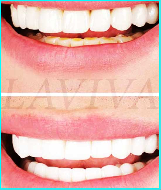celebs teeth before and after