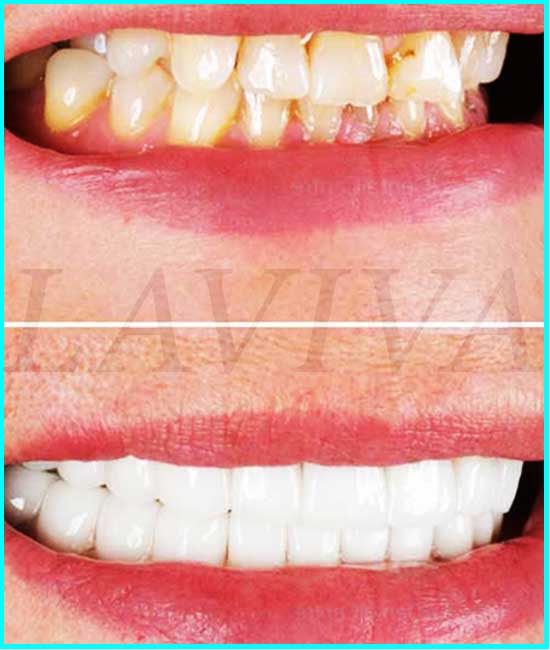 blanchiment dentaire avant et après