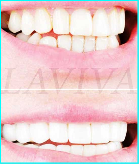 corone dentali dei denti anteriori prima e dopo