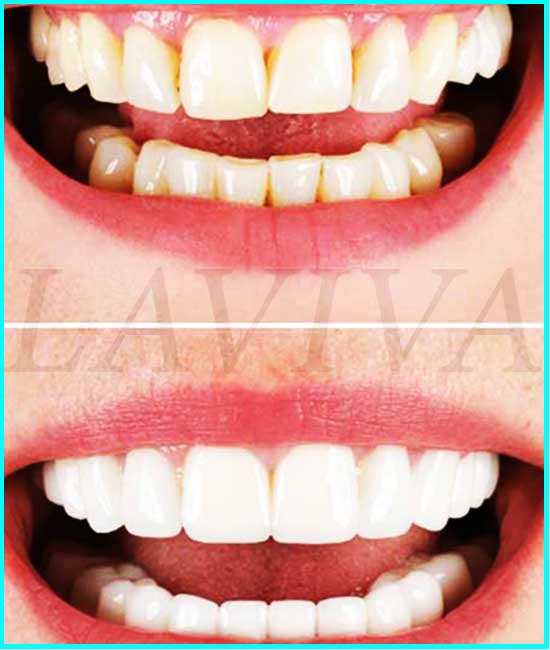 dentes cariados antes e depois