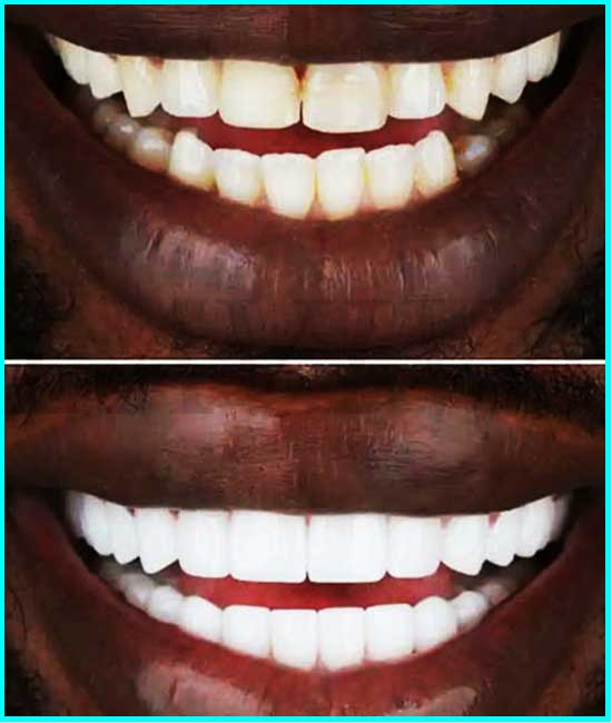 photos avant et après des facettes dentaires