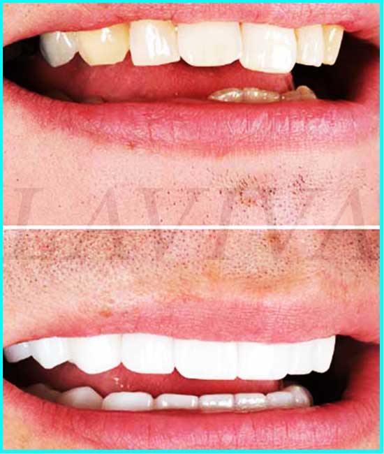 teeth before veneers