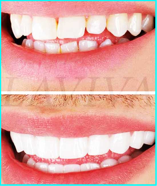 prima e dopo il digrignamento dei denti