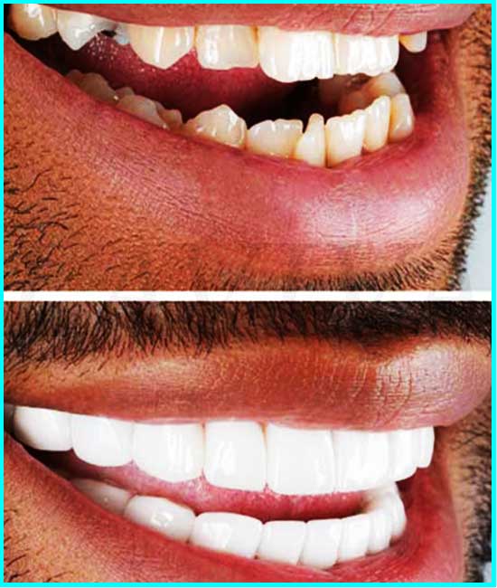 avant et après le pont dentaire avant